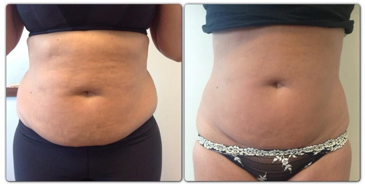 Coolsculpting Near Me