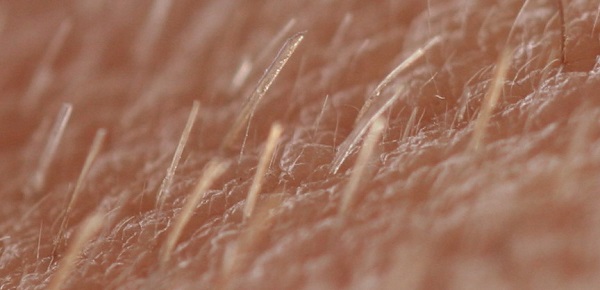 Laser hair removal