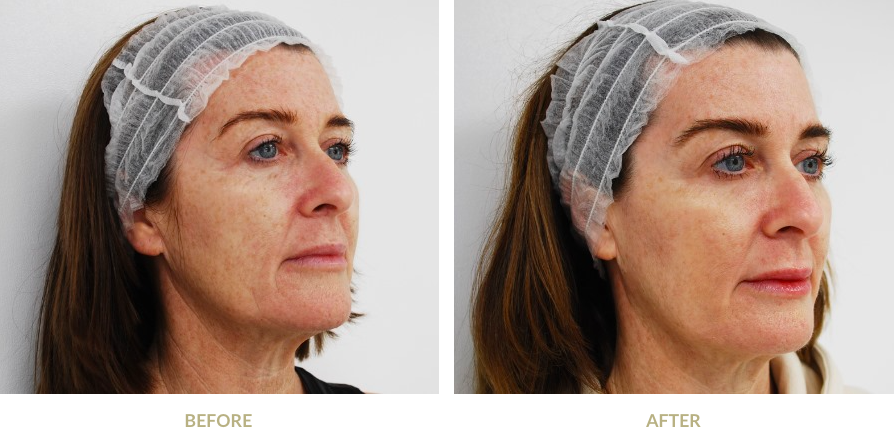 Face before and after Profhilo treatment
