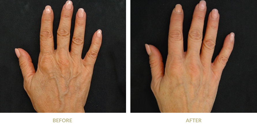 Hand before and after Profhilo treatment