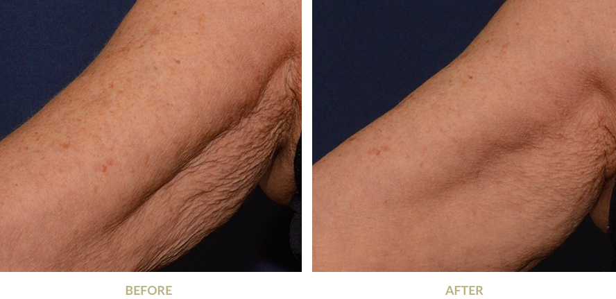 Arm before and after Profhilo treatment