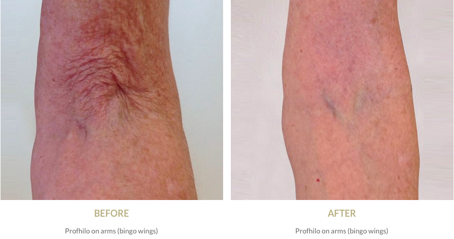 Profhilo on arms (bingo wings) - before and after pictures
