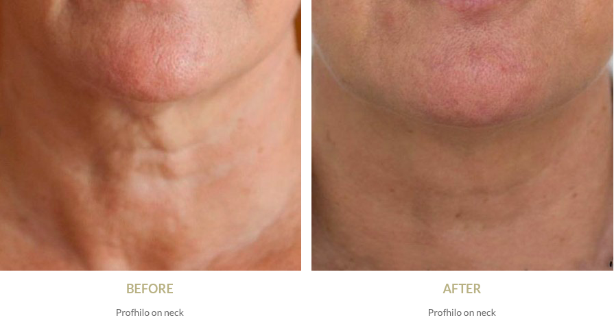 Profhilo neck treatment - before and after pictures