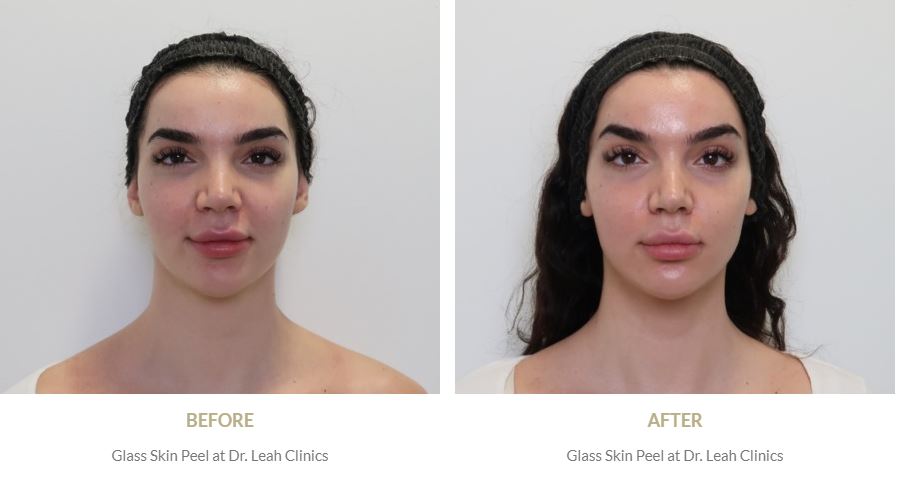 How to Get Glass Skin KBeauty Skin Care Treatment
