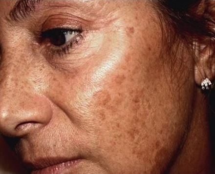 Hyperpigmentation on face