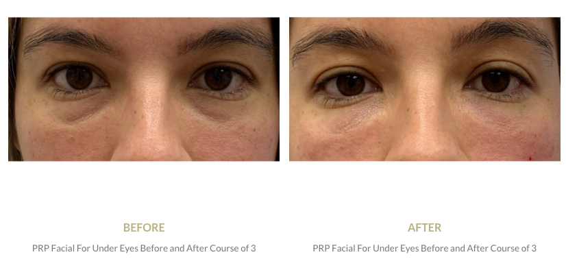 NEW Under-eye Treatment! PRP Under Eyes.