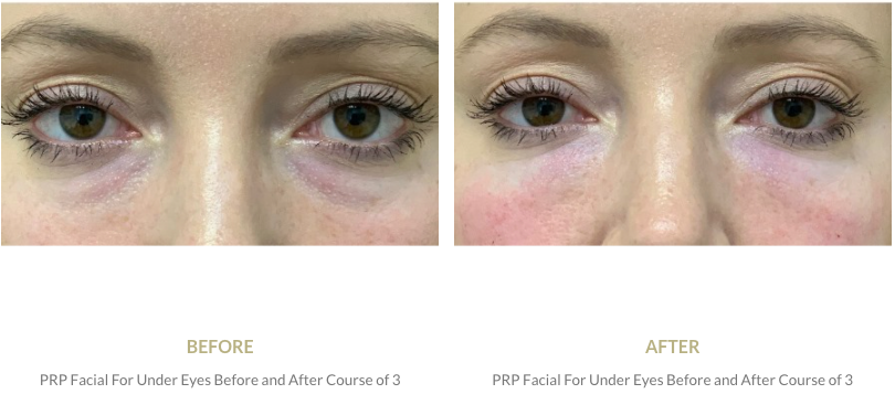 NEW Under-eye Treatment! PRP Under Eyes.