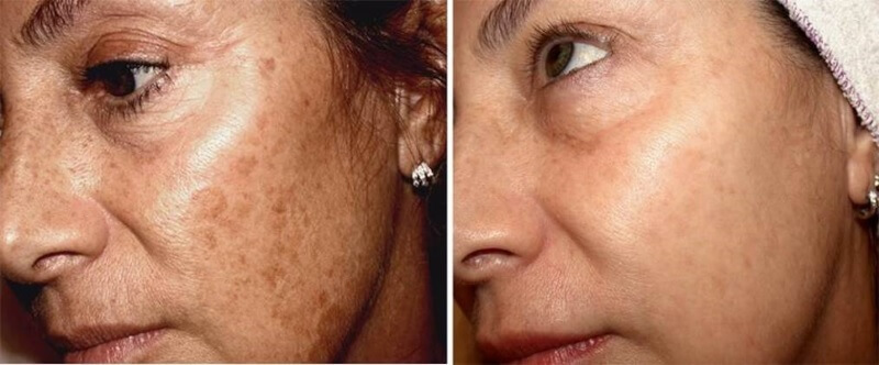 Hyper pigmentation before and after treatment