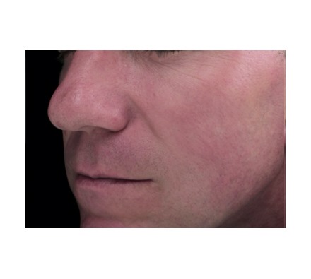 Rosacea treated with harmony vascular laser 