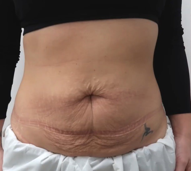 Before and after Dr Leah's Mummy Tummy Makeover treatment
