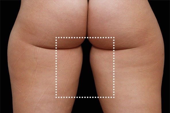 Thigh gap before and after EmSculpt Neo. Photos courtesy of Diane Duncan, M.D.