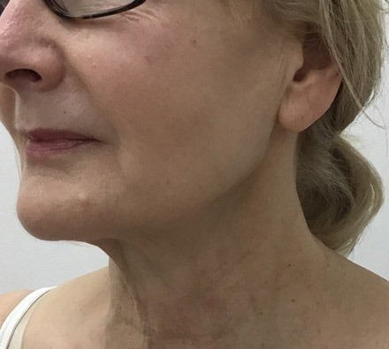 Ultherapy 3/4 Face Before and After, *Individual results may vary