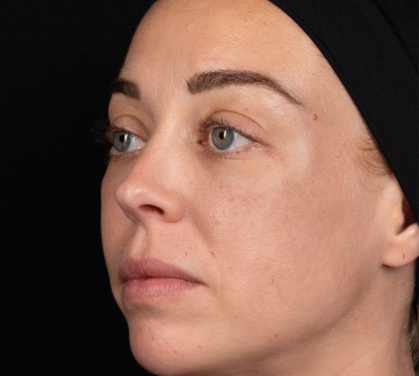 2 days after treatment