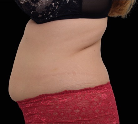 Female abdomen before and after EmSculpt Neo. Photos courtesy of BTL Aesthetics.