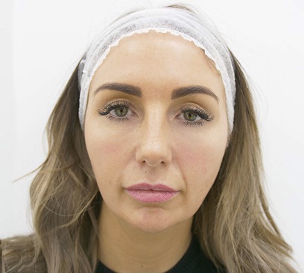 Tear trough treatment before and after
