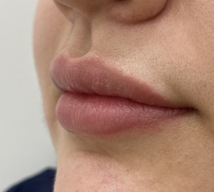 Lip filler (1ml MaiLi) before and after