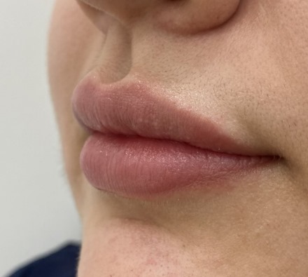 Lip Filler 1ml MaiLi Before and After