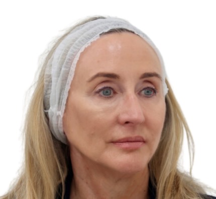 Before and after thread lift
