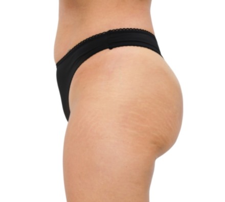 Lanluma Bum Lift Before and After 