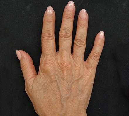 Profhilo hands before and after