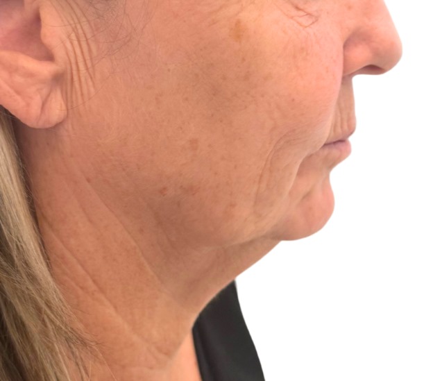 Quantum RF before and 10 weeks after treatment