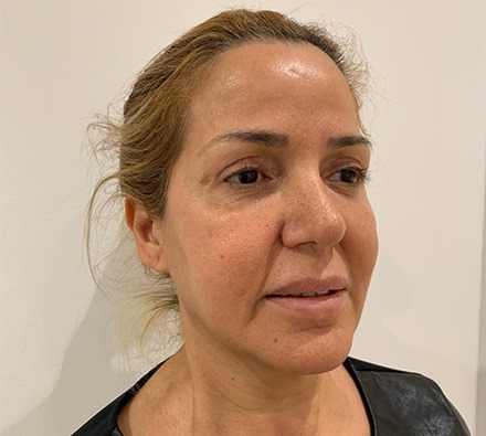 Liquid facelift before and after