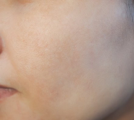 Before and after course of 6 Dermapen treatments with Uber peel