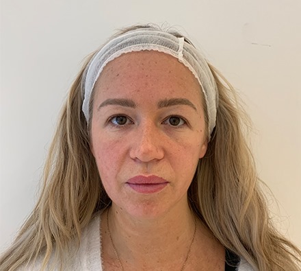 Fox eye lift before and after 