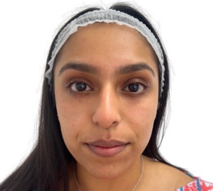 Polynucleotide Under-eye Treatment
