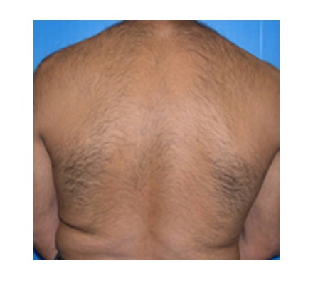 Laser hair removal London| Soprano Ice Laser Laser hair removal London| Soprano Ice Laser