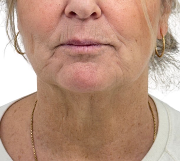 Quantum RF before and 10 weeks after treatment