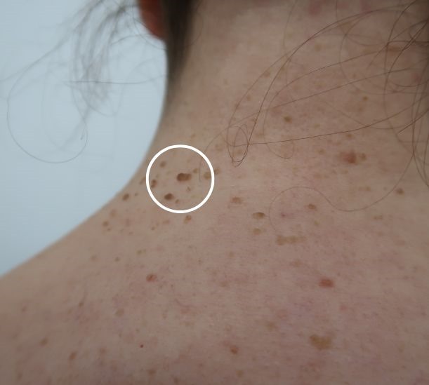 Mole removal before and after results