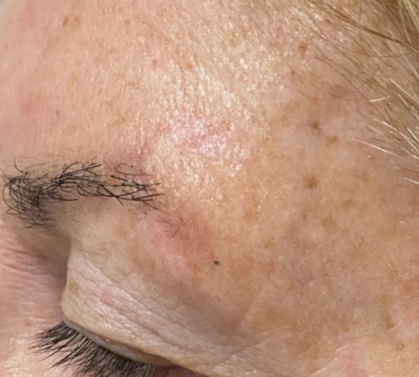 Skin imperfection before and after cryotherapy