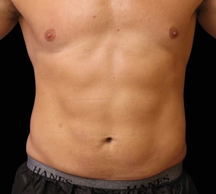 Male abdomen before and after EmSculpt Neo. Photos courtesy of Richard Goldfarb, M.D.