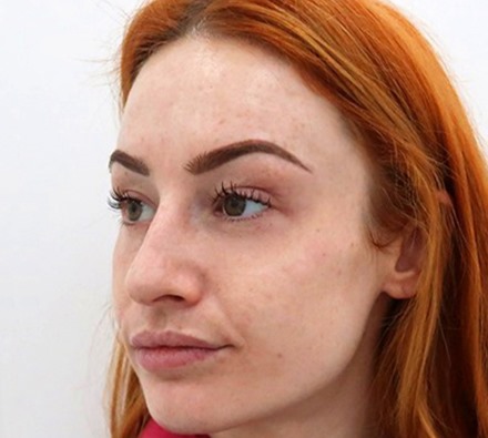 Fox eye lift before and after 