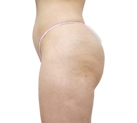 Lanluma Bum Lift Before and After