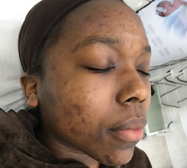 Obagi Blue Radiance peel (x3) paired with at-home Obagi skincare.