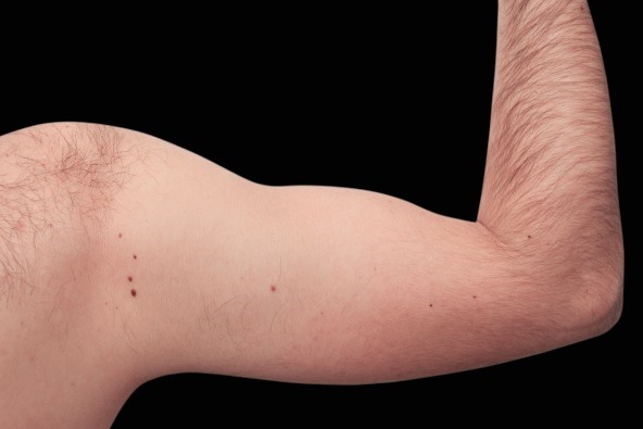 Male arm before and after Emsculpt Neo. Photos courtesy of Raminder Saluja, M.D.