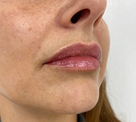 MaiLi Lip Dermal Filler (1ml) Before and Immediately After