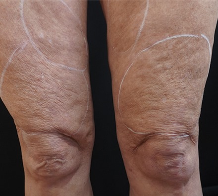 Legs Morpheus 8 Before and After, *Individual results may vary