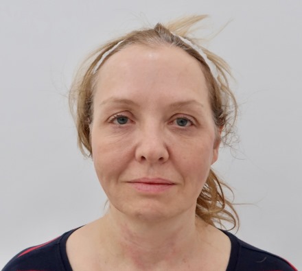 Before and After MINT PDO Thread Lift - Face