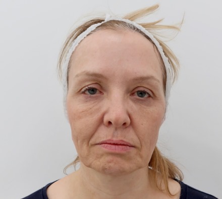 Before and After MINT PDO Thread Lift - Face