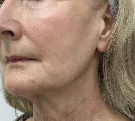 Ultherapy 3/4 Face Before and After, *Individual results may vary