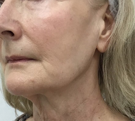 Ultherapy before and after