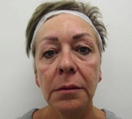 Before and After Silhouette Soft Thread Lift 
