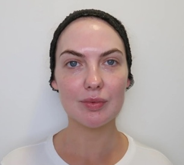 Before and after glass skin peel