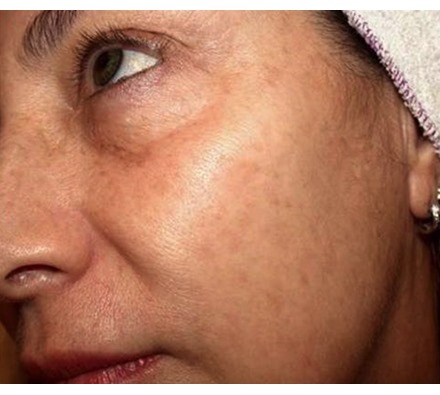 Before after after pigmentation laser treatment