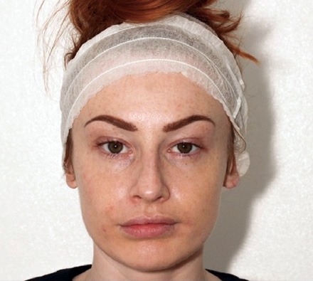 Fox eye lift before and after 
