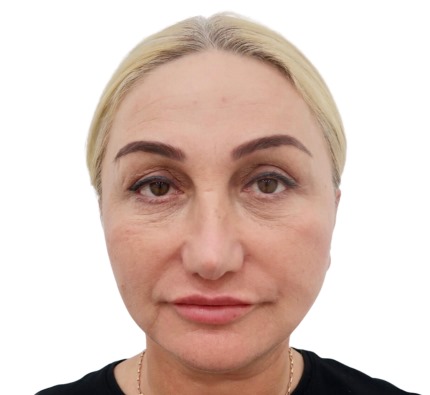 Before and after thread lift