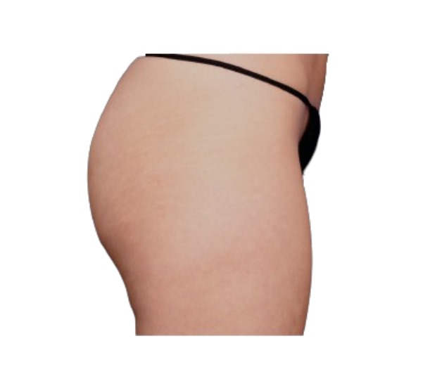 EmSculpt Neo bum lift before and after